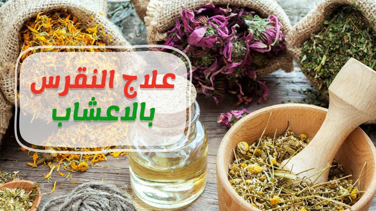 علاج مرض النقرس بالاعشاب , ما هو النقرس وكيفية التخلص منه