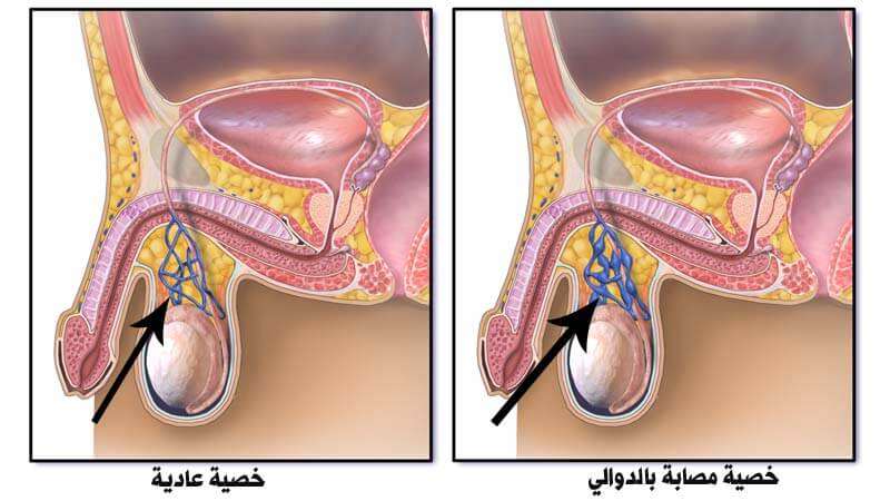 علاج الدوالي الخصية بالاعشاب , سحر الاعشاب في علاج دوالي الخصية