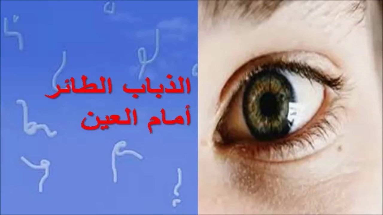 علاج الذبابة الطائرة بالعسل , ما هى الذبابة الطائرة وعلاجها