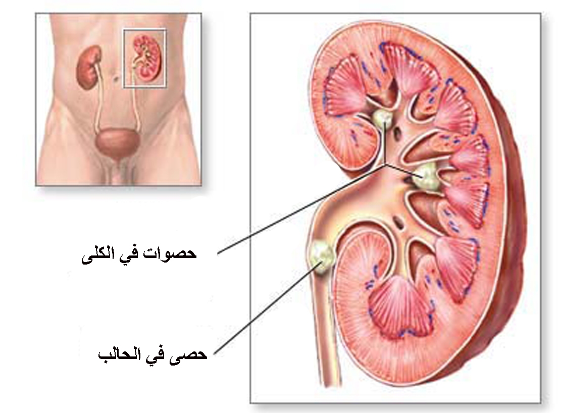 هكذا شفيت من حصوات الحالب بدون جراحة , علاج حصوة الحالب