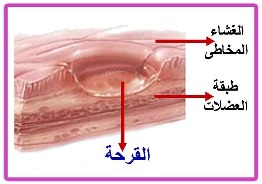 اعراض ثقب المعدة - اسباب وعلاج قرحة المعدة Unnamed File 28