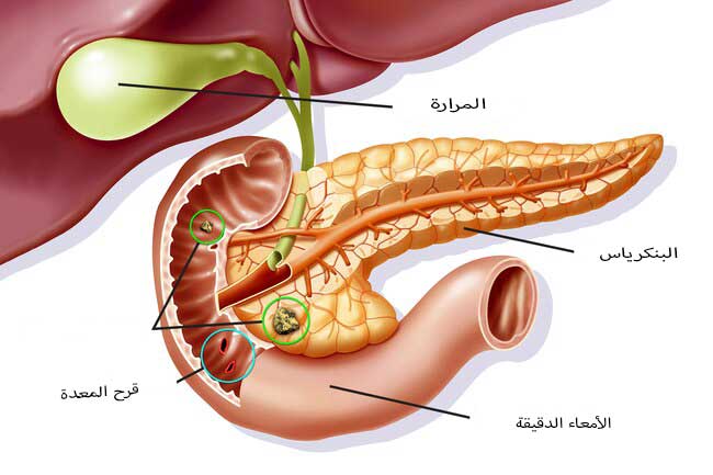 اعراض ثقب المعدة - اسباب وعلاج قرحة المعدة Unnamed File 24