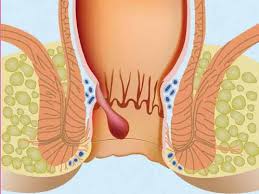 ماهو علاج الناسور , اسهل طريقة لعلاج الناسور