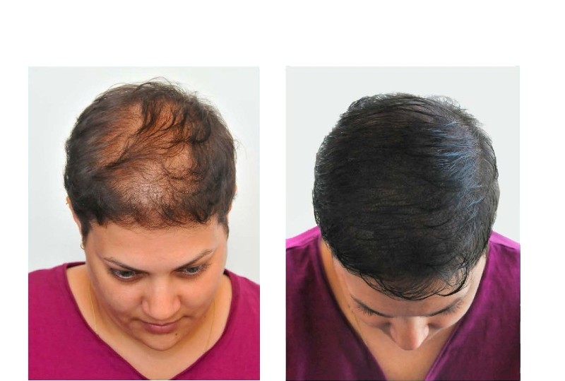 زراعة الشعر في امريكا , امريكا وتقدمها فى زراعة الشعر لا صلع بعد الان