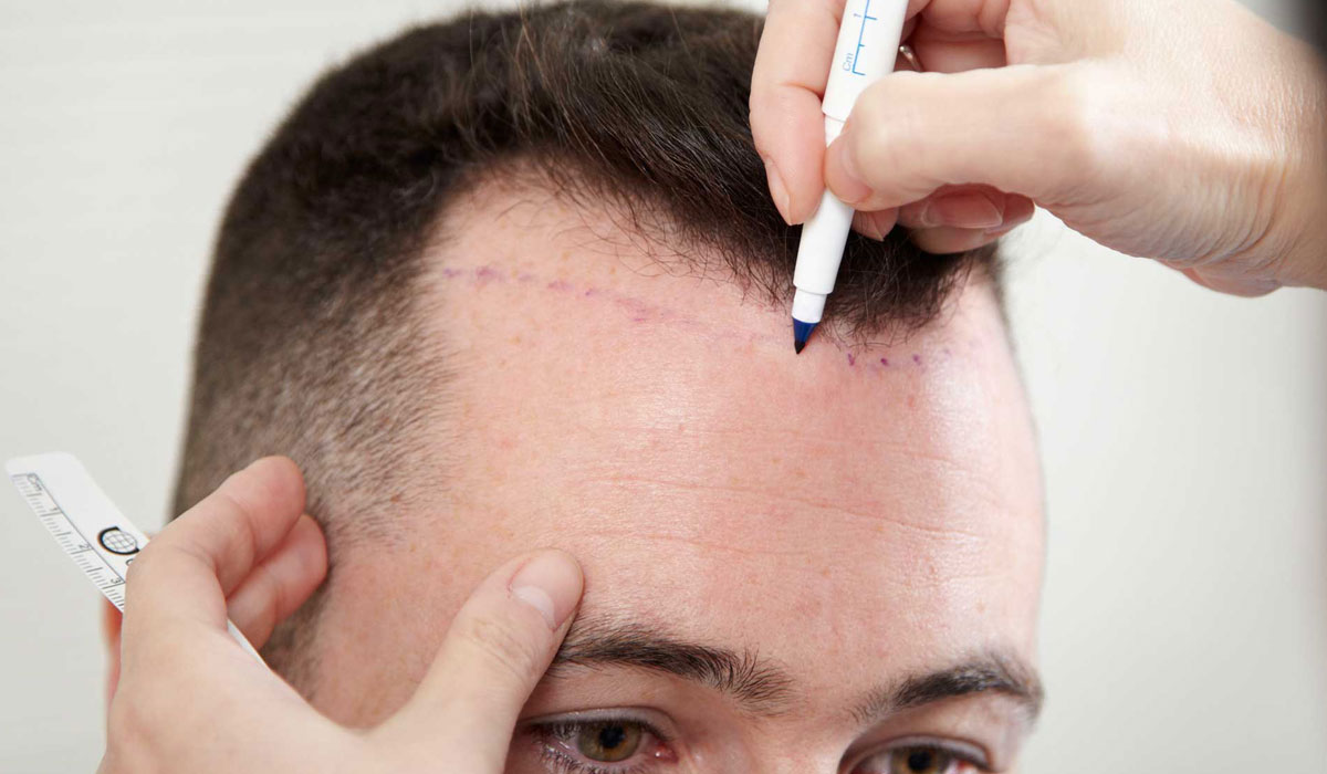 تكلفة زراعة الشعر في مصر , كم ثمن زرع الشعر بمصر