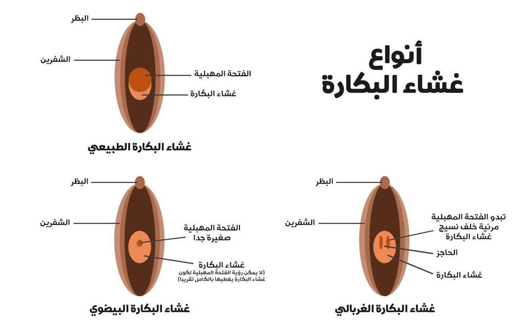 شكل غشاء البكارة , لغشاء البكارة انواع كثيرة تعرفي عليها