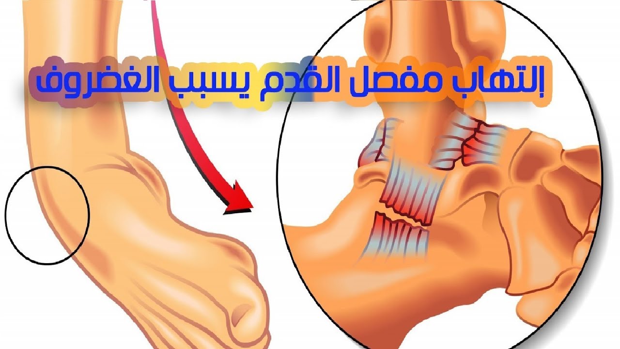 الم الكاحل عند المشي-اسباب الام الكاحل وارشادات يجب اتباعها عند تلقي العلاج 6432 8