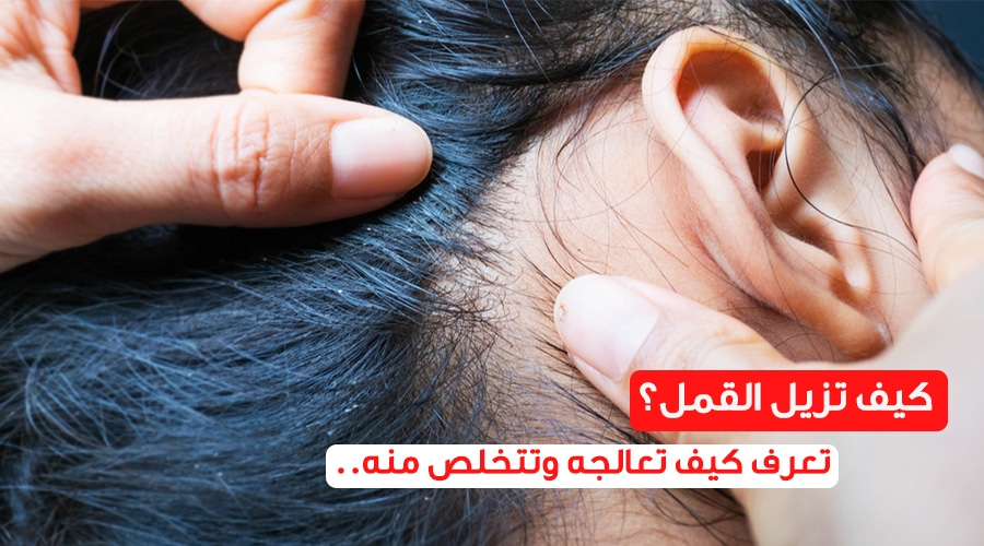 علاج القمل , تعرفوا أزاى نعالج القمل