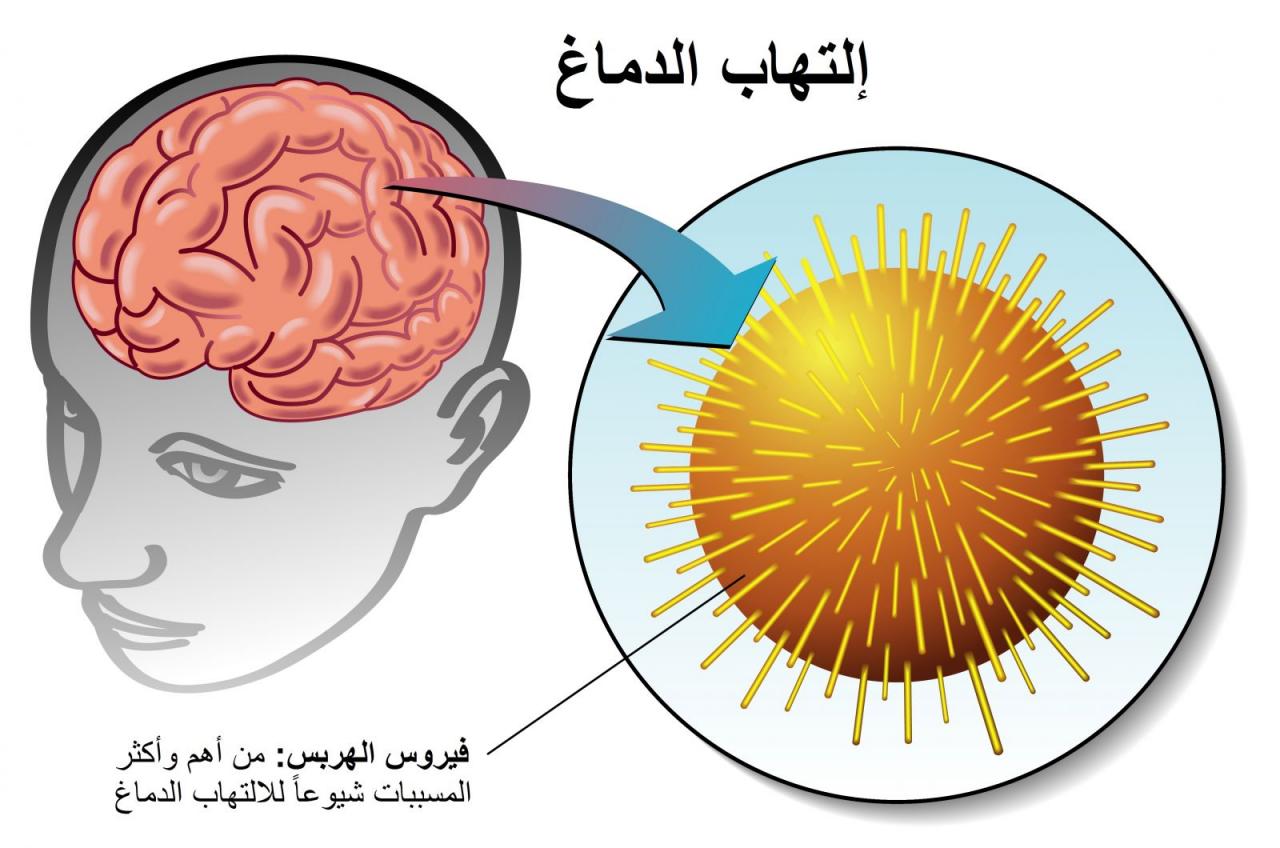 اعراض التهاب المخ والاعصاب , اعراض واسباب التهاب الدماغ