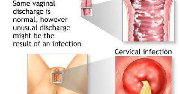 علاج الافرازات ذات الرائحه الكريهه للبنات , حافظي على نظافتك لمنع الالتهابات